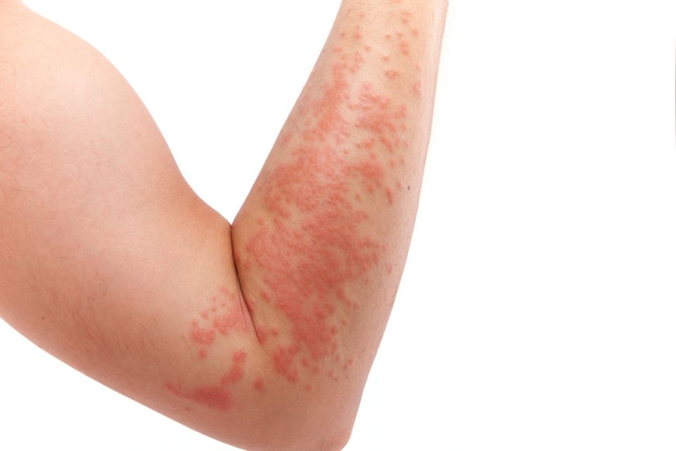 Amikor a duzzanat életet veszélyeztet – Az angioödéma, amiről mindenkinek tudnia kell