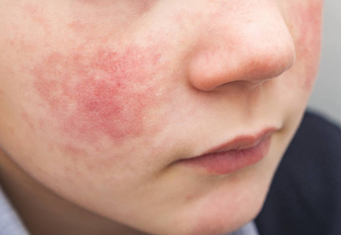 Szinte sosem hallottunk ezekről a betegségekről, mégis hetente kapják el a gyerekeink – Lepke himlő és társai